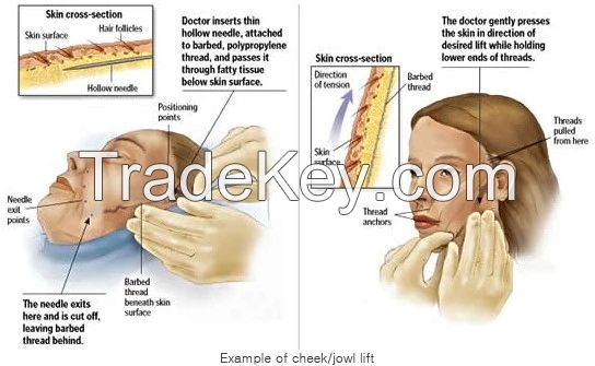 Polydioxanone De Levage De Facial De Beaute Avec Le Levage De De Plla Pdo PDA D'aiguille