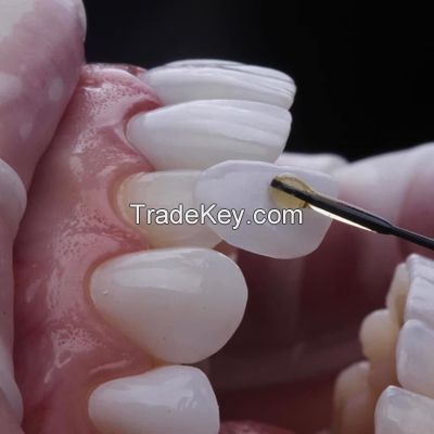 Emax Crowns - China Dental Lab Dental Crowns in Good Quality and Good Esthetics