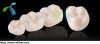 Dental CAD/CAM Wieland &amp; Lava &amp; Cercon Zirconia all ceramic aesthetic crown