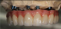 Dental Treatment Dental Metal Ceramic Crown Made  Dental Lab in